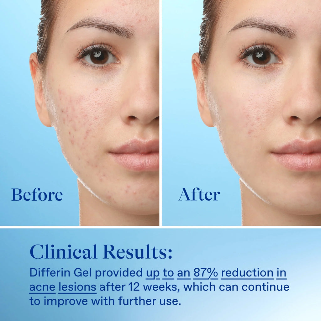 0.1% Adapalene Acne Treatment Gel O327