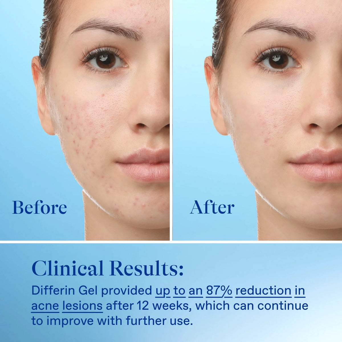 0.1% Adapalene Acne Treatment Gel O327